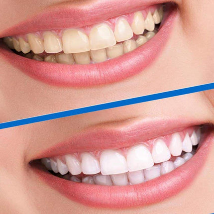 Crofta 14 Pcs Teeth Whitening Strips Home Teeth Bleaching Intensive Stains Remover