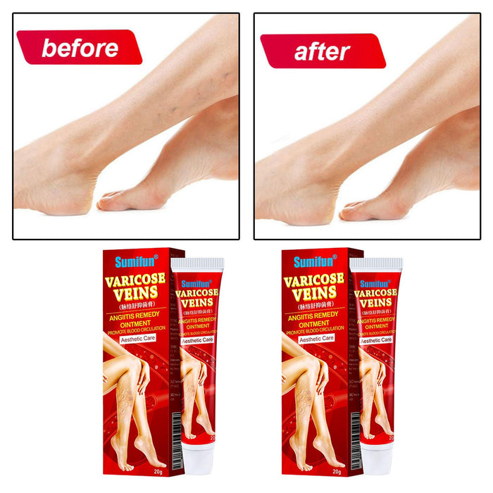 Crofta 2 Pack Varicose Vein Ointment Vasculitis Cream Varicosity Removal Plaster