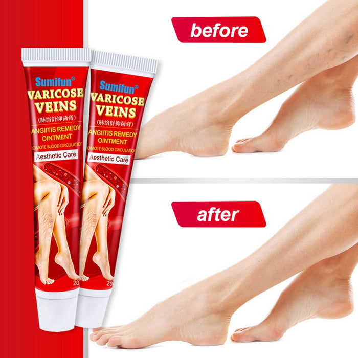 Crofta 2 Pack Varicose Vein Ointment Vasculitis Cream Varicosity Removal Plaster