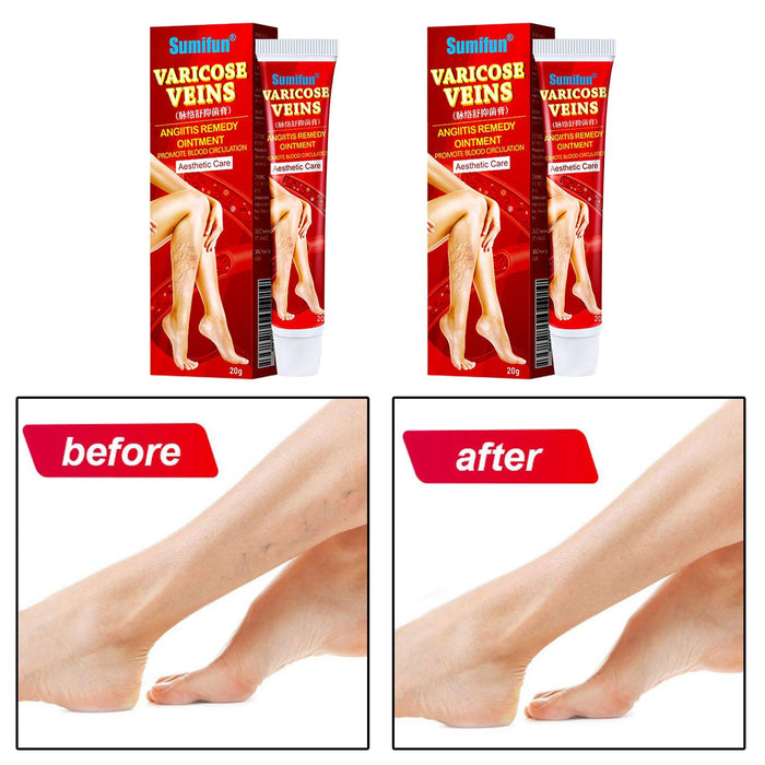 Crofta 2 Pack Varicose Vein Ointment Vasculitis Cream Varicosity Removal Plaster