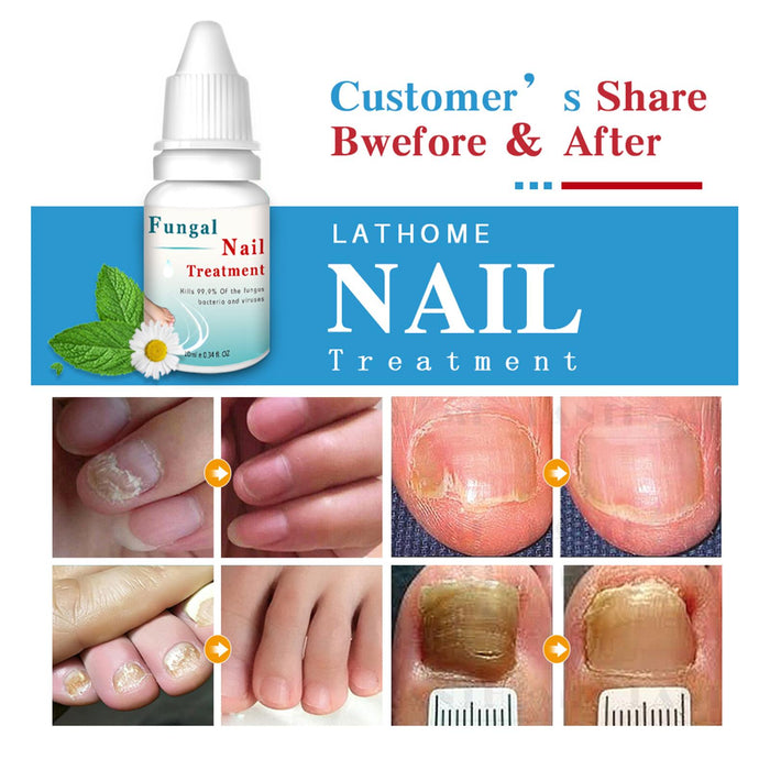 10ml Fungal Nail Toe Nail Treatment Essences Anti-Fungal Nail Repair Gel