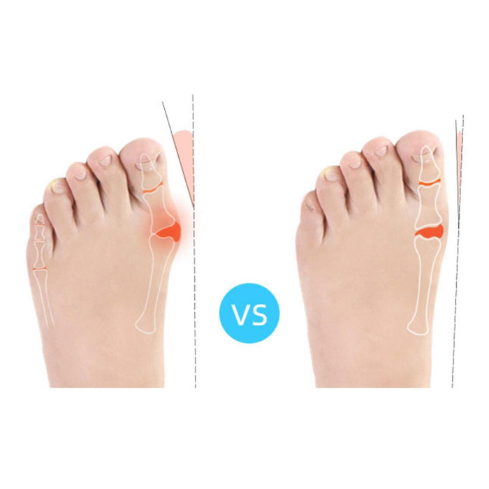 2 Pieces Bunion Corrector Straightening Day Night Support for Hammer Toe